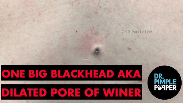 One Big Blackhead aka Dilated Pore of Winer