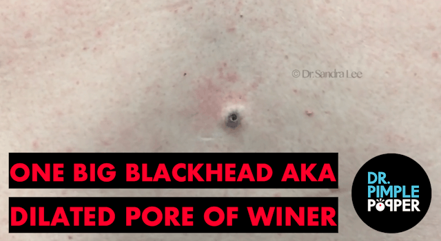 One Big Blackhead aka Dilated Pore of Winer