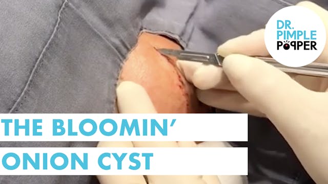 The Bloomin' Onion Cyst 