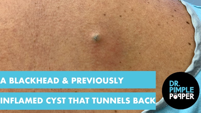 A Blackhead & A Previously Inflamed Cyst that Tunnels Back