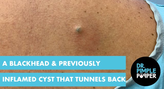 A Blackhead & A Previously Inflamed C...