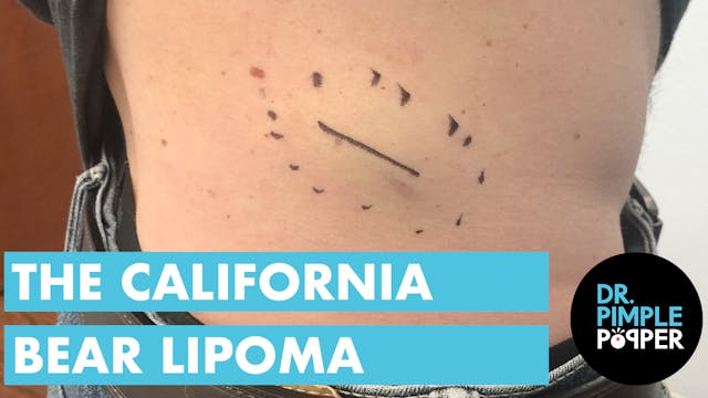 The California Bear Lipoma