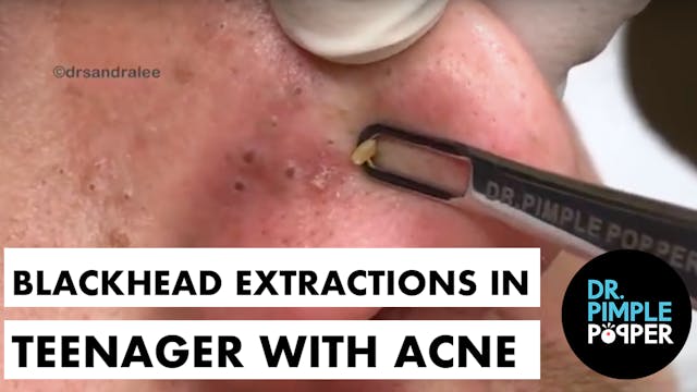 Blackhead Extractions in a Teenager