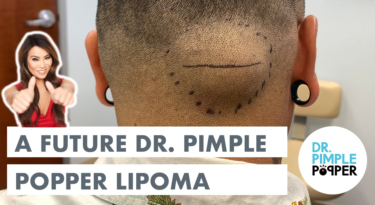 A Future Dr. Pimple Popper Lipoma