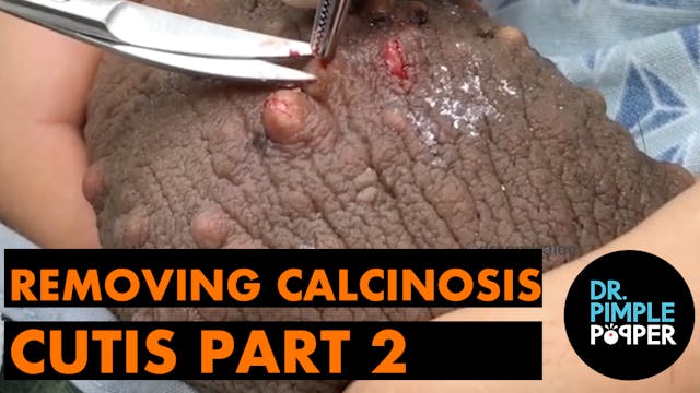 Removing Calcinosis Cutis: Pt.2