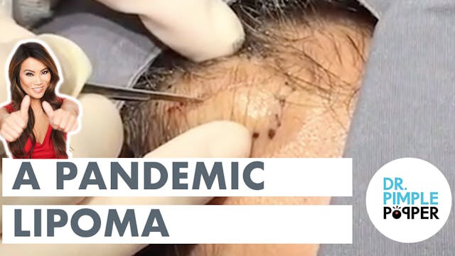 A Pandemic Lipoma