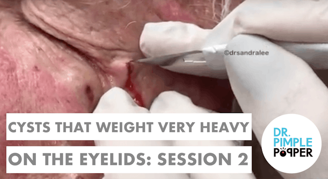 Cysts that weigh very HEAVY on the EY...