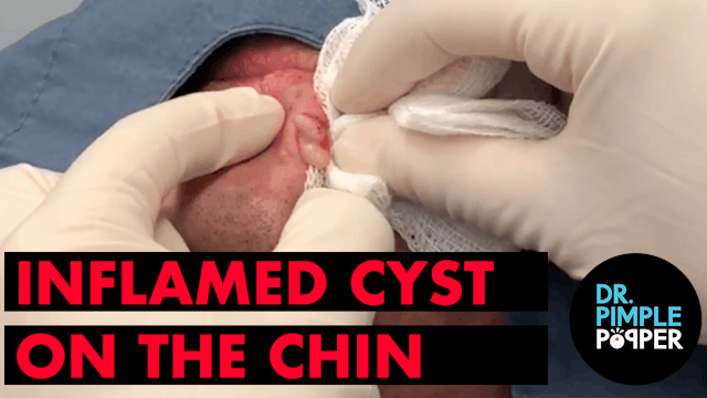 Inflamed Cyst on the Chin