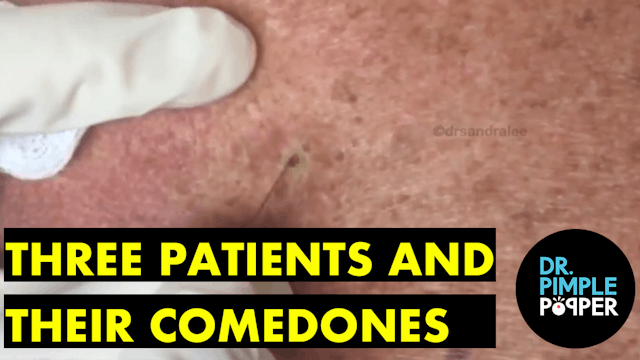 Three patients and their comedones extracted