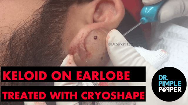 Keloid on Earlobe treated with Cryoshape - Before & Afters and more Treatment