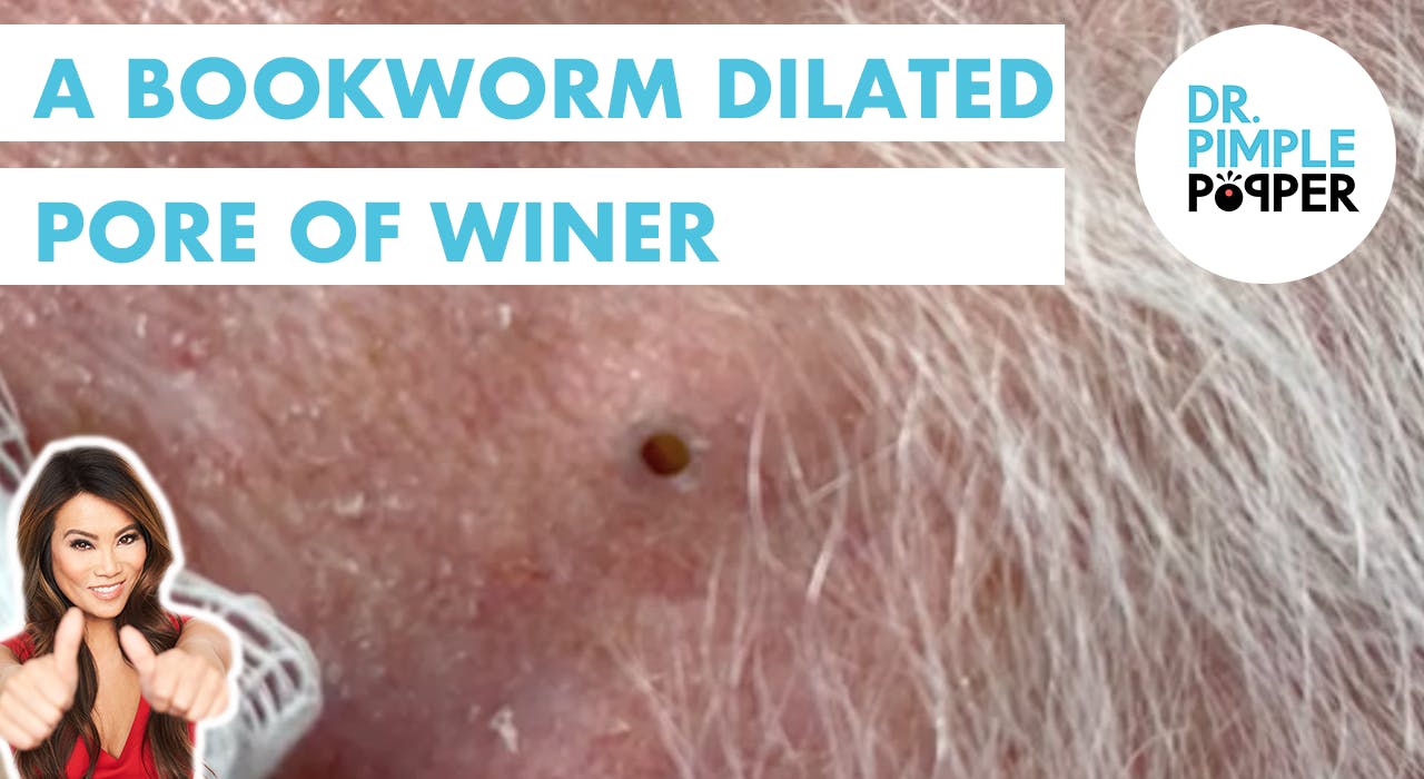 A Bookworm Dilated Pore Of Winer Recently Added Dr Pimple Popper 