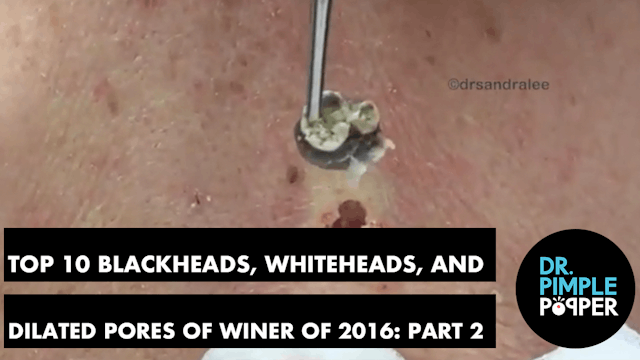 My Top 10 BEST Blackheads, Whiteheads...