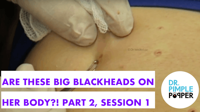 Are these BIG BLACKHEADS on her body?...
