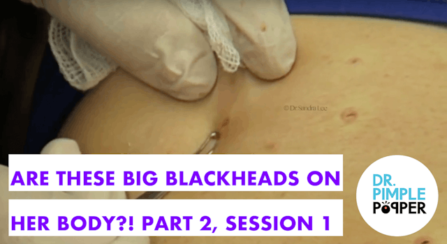 Are these BIG BLACKHEADS on her body?! Part 2, Session 1