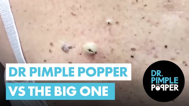 Dr Pimple Popper vs The Big One - A B...