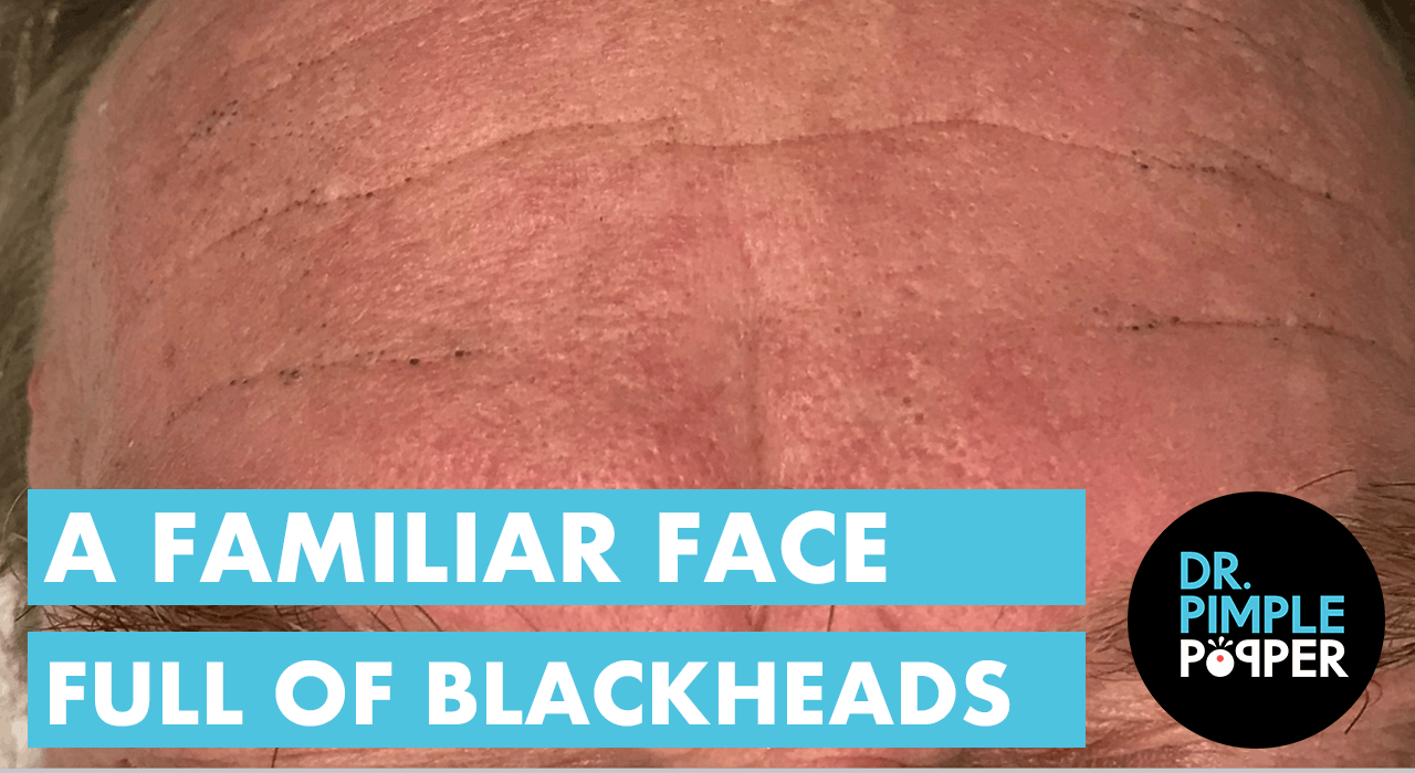 A Familiar Face Full of Blackheads Dr. Pimple Popper