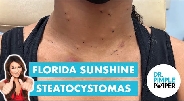 Florida Sunshine Steatocystomas