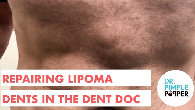 Repairing Lipoma Dents in the Dent Doc