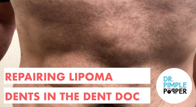 Repairing Lipoma Dents in the Dent Doc
