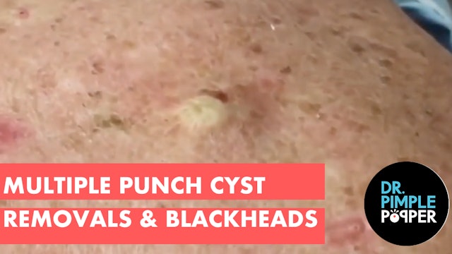 Multiple punch removals of Cysts on the Back & Blackhead Extractions