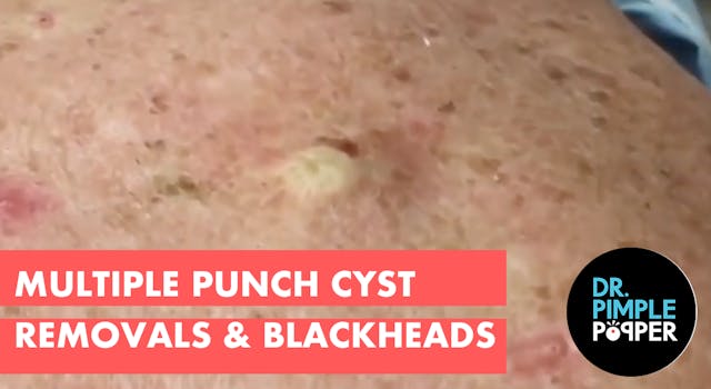 Multiple punch removals of Cysts on t...