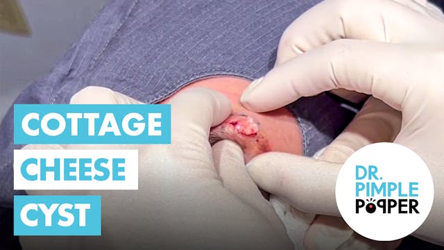 Cottage Cheese Cyst