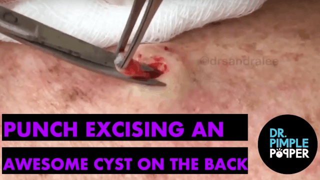 Punch excising an AWESOME cyst on the...