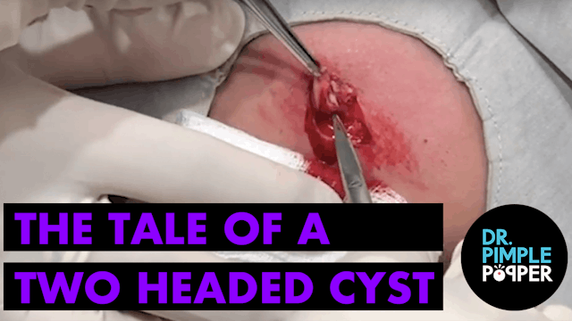The Tale of a Two Headed Cyst