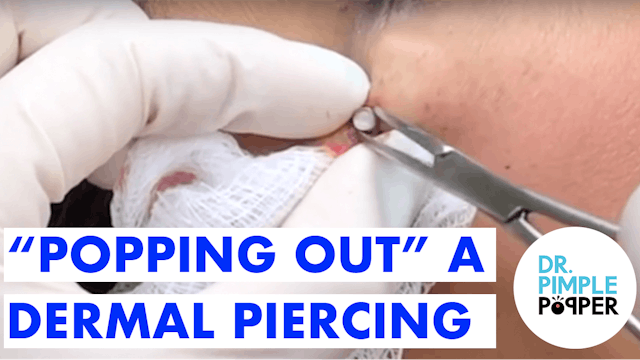 "Popping Out" a Dermal Piercing
