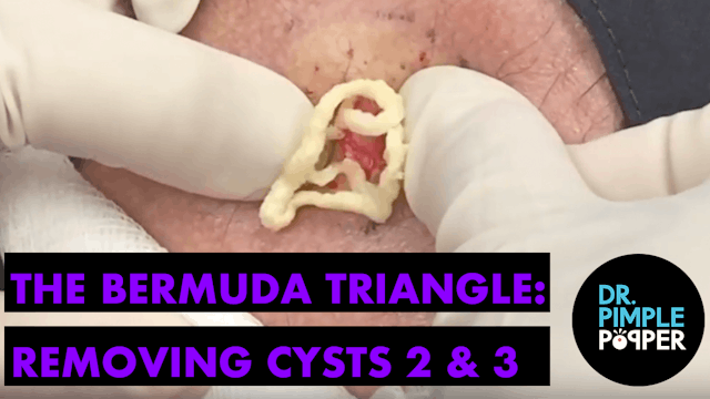 The Bermuda Triangle: Removing Cyst 2 & 3