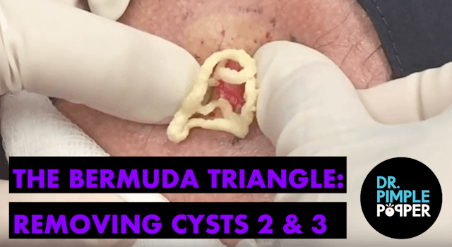The Bermuda Triangle: Removing Cyst 2...