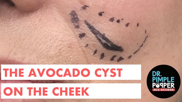 The Avocado Cyst on the Cheek