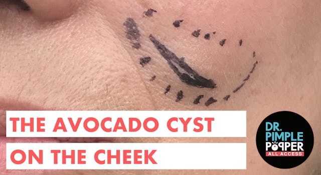 The Avocado Cyst on the Cheek