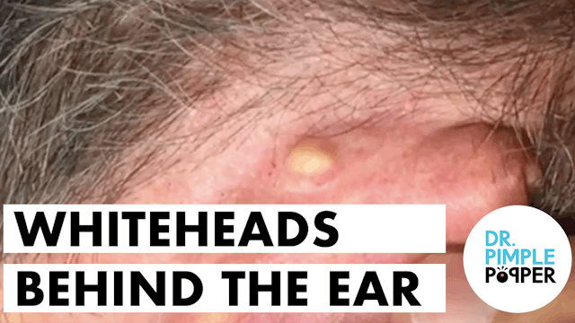 Whiteheads behind the ears, extracted