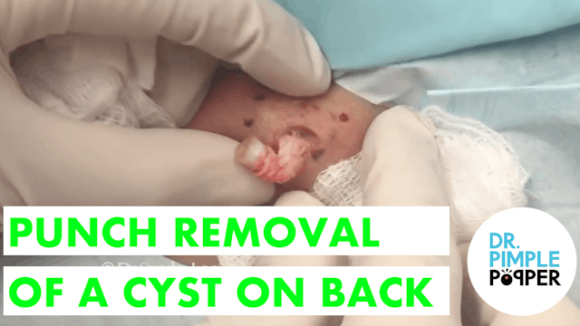 Punch Removal Cyst on Back