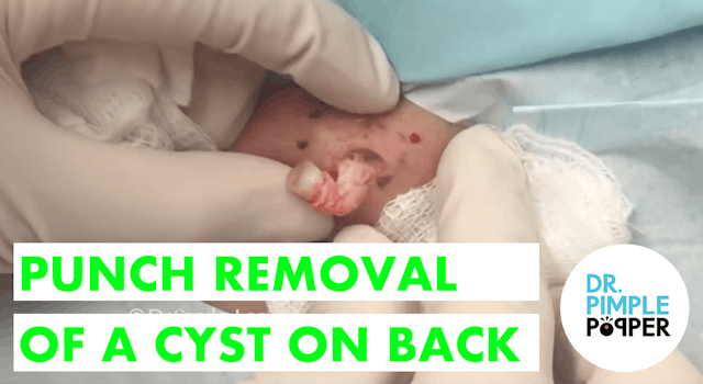 Punch Removal Cyst on Back