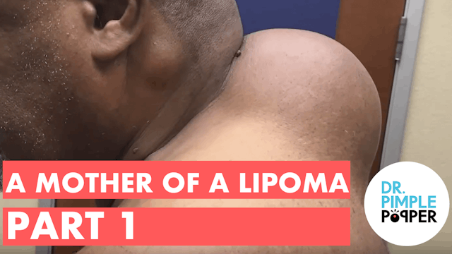 A Mother of a Lipoma (Part 1)