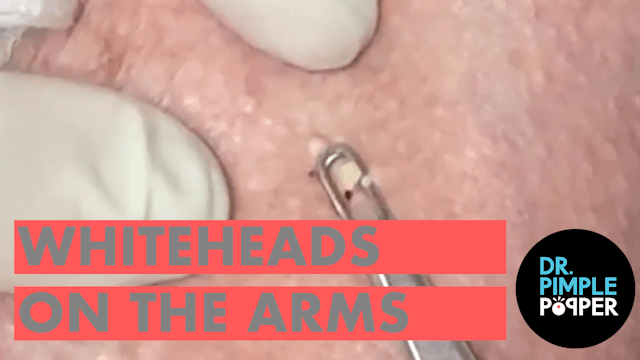 Whiteheads on the arms, caused by chr...