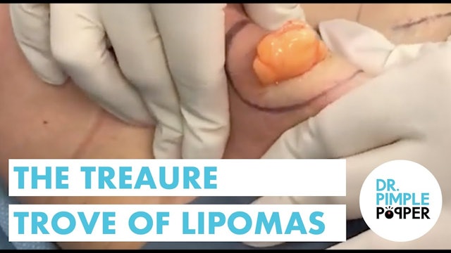The Treasure Trove of Lipomas 