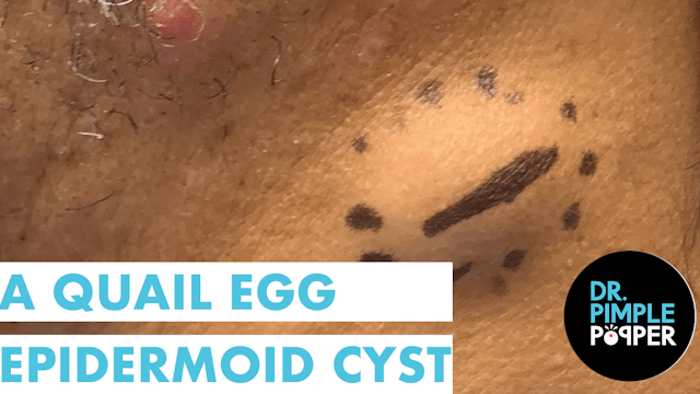 A Quail Egg Epidermoid Cyst
