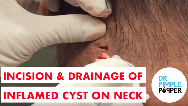Incision & Drainage of an Inflamed Cyst on the Neck