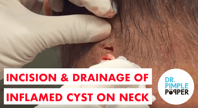 Incision & Drainage of an Inflamed Cyst on the Neck