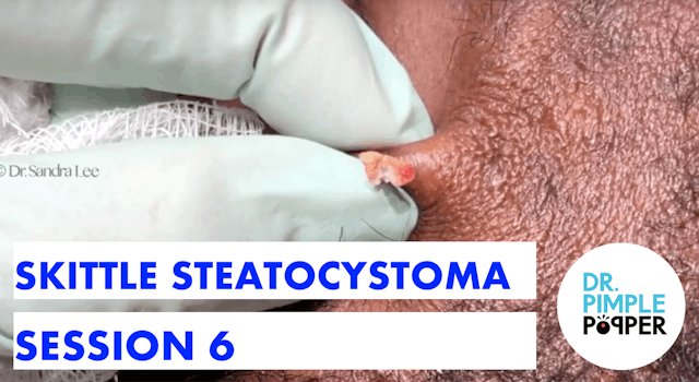 YES, More Skittle Steatocystoma - Ses...