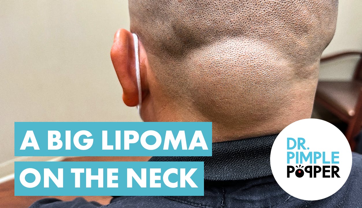 A Big Lipoma On The Neck Dr Pimple Popper