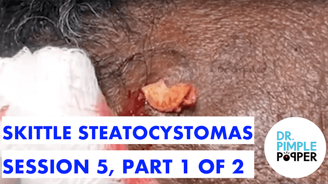 A Tough Skittle Steatocystoma Session- Session 5, Part 1 of 2