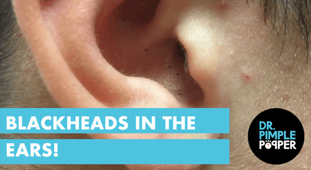 Blackheads in the Ears! Extractions b...