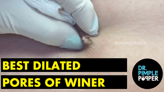 My Best Dilated Pores of Winer: A Dr Pimple Popper Compilation