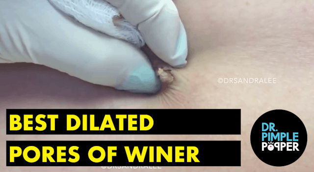 My Best Dilated Pores of Winer: A Dr ...