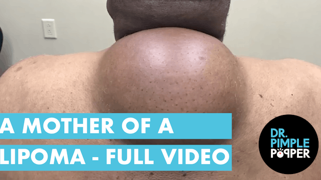 A Mother of a Lipoma - FULL VIDEO