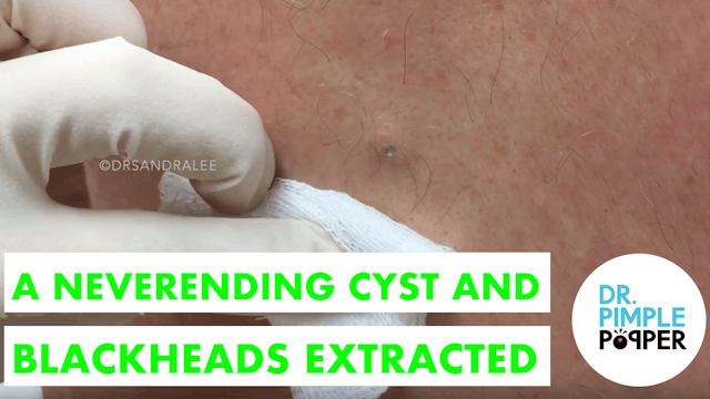 A Never Ending Cyst & Blackhead